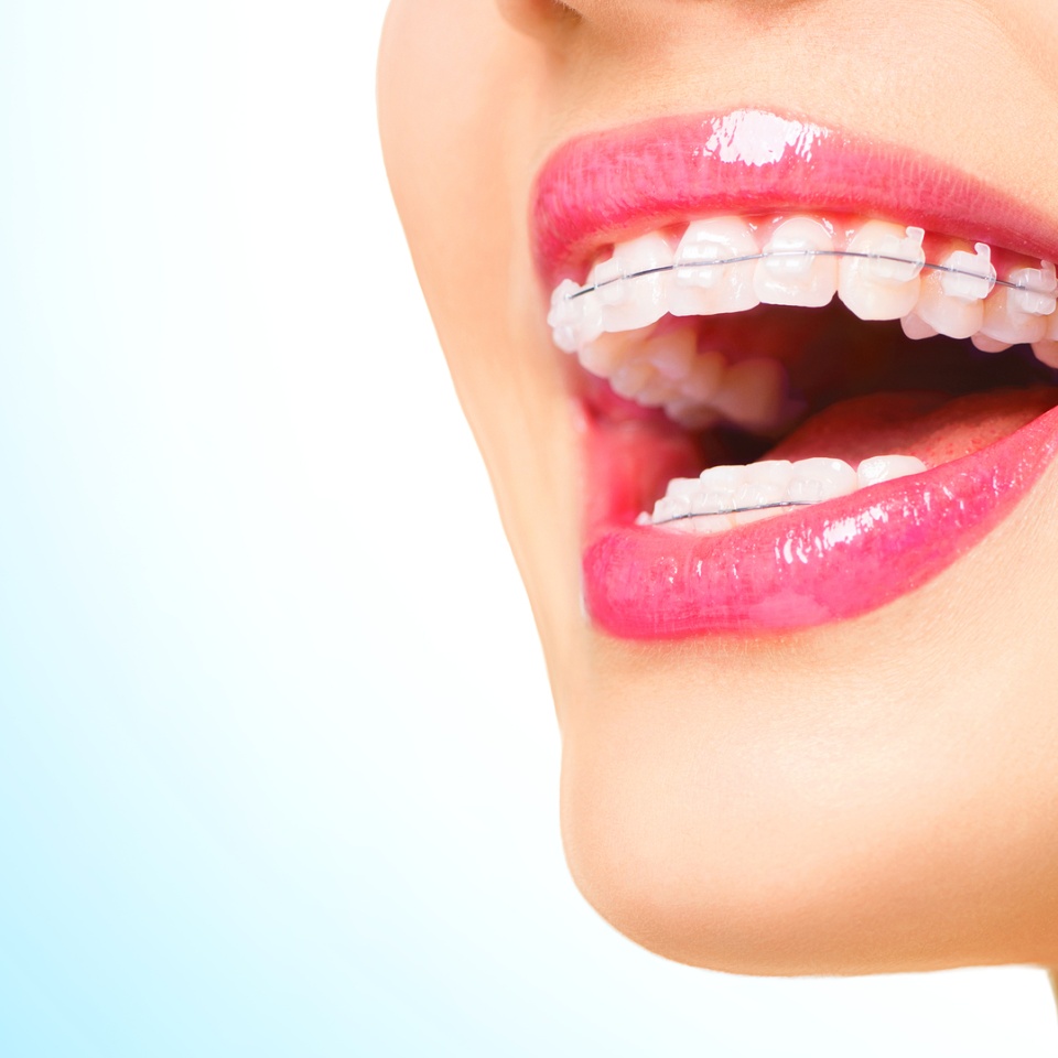 Braces. Beautiful Woman healthy smile close up. Closeup Ceramic Braces on Teeth. Beautiful Female Smile with Braces. Orthodontic Treatment. Dental care Concept. Beautiful Lips and Teeth