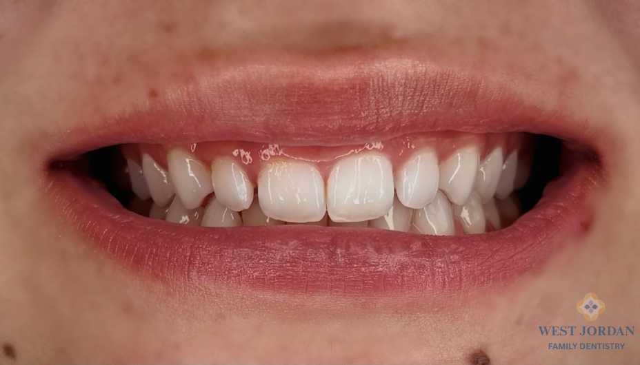 Close-up of a person's mouth showing clean, straight teeth; West Jordan Family Dentistry logo visible in the lower right corner.
