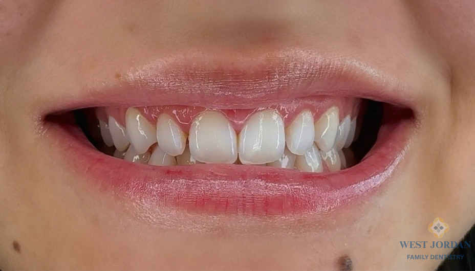 Close-up of a person's smile showing straight upper and lower teeth with visible gums; a small logo for West Jordan Family Dentistry is in the bottom right corner.